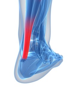 Ankle Tendonitis