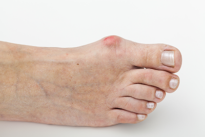 Bunion Treatment For Diabetics