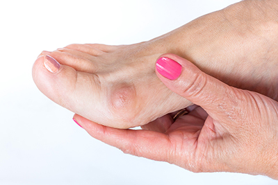 Prevent Bunion Pain Before Surgery