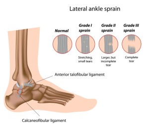 ankle sprain podiatrist Rowlett