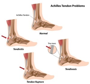 achilles tendon injury, heel pain, podiatrist Rowlett