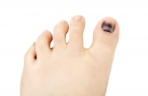 Ingrown Toenails