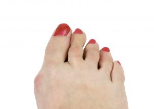 hammertoe