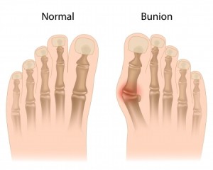 bursituts treatment Rowlett TX foot doctor