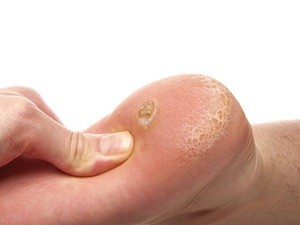 corns and calluses