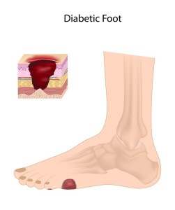 diabetic foot treatment