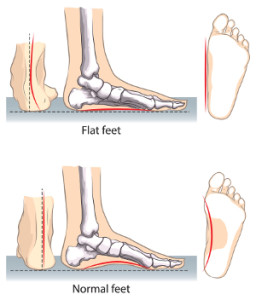Treatment for Flat Feet