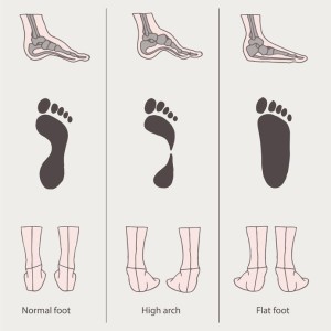 Flat Feet Specialist Rowlett and Royse 