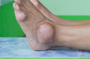 foot gout podiatrist Rowlett TX