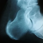 heel spur x-ray