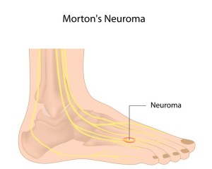 morton's neuroma