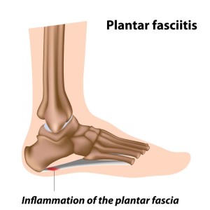 Foot, Ankle and Heel Pain - Foot Werks Podiatry-totobed.com.vn