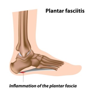 plantar fasciitis heel pain ankle pain