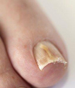 toenail fungus podiatry care